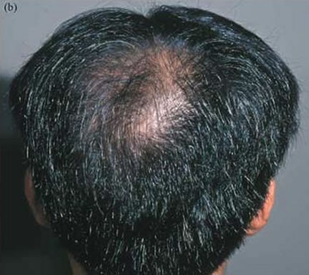 Clinical Photo - B - After treatment